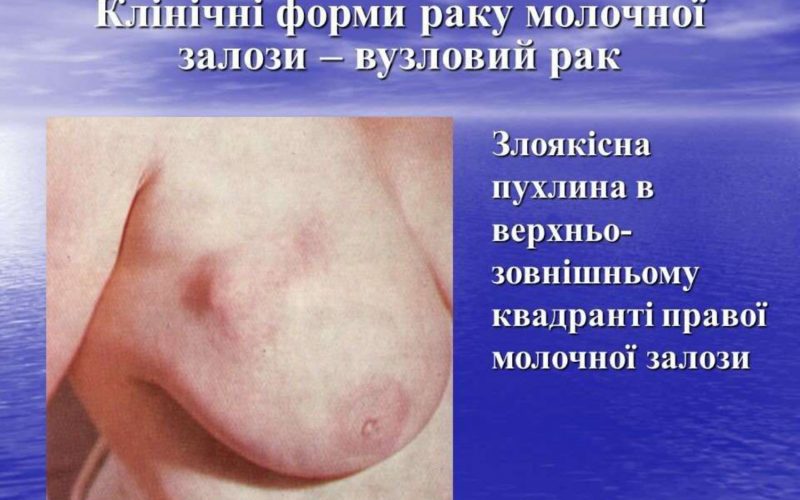 20-zhovtnia-vseukrainskyj-den-borotby-iz-zakhvoriuvanniam-1_page-0009