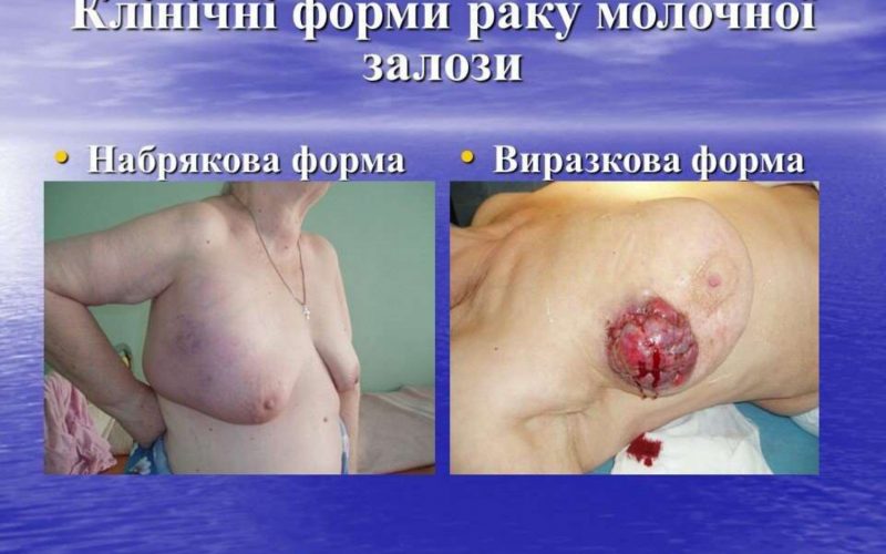 20-zhovtnia-vseukrainskyj-den-borotby-iz-zakhvoriuvanniam-1_page-0011