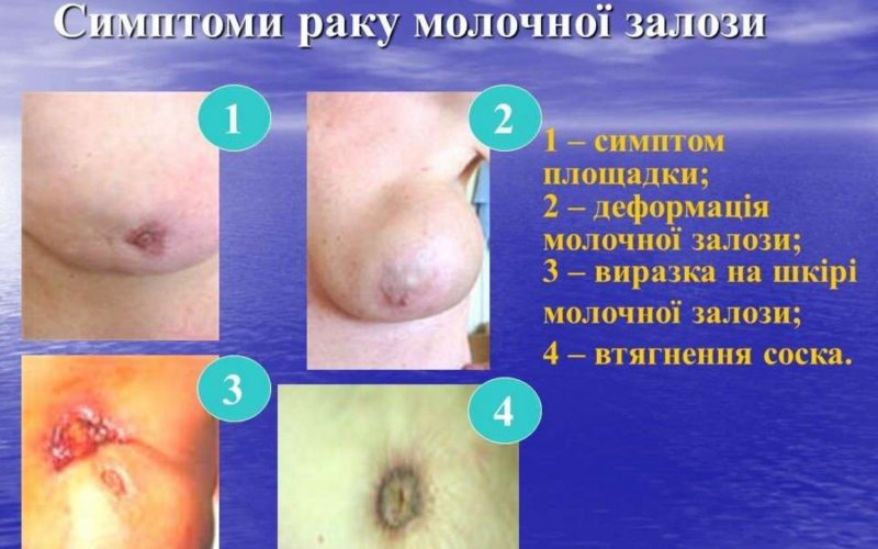 20-zhovtnia-vseukrainskyj-den-borotby-iz-zakhvoriuvanniam-1_page-0012