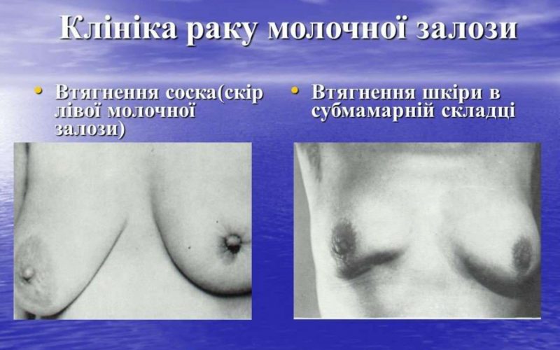 20-zhovtnia-vseukrainskyj-den-borotby-iz-zakhvoriuvanniam-1_page-0013